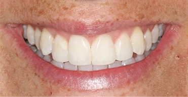 After - Nuvo Dental Implant Centre