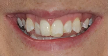 Before - Nuvo Dental Implant Centre
