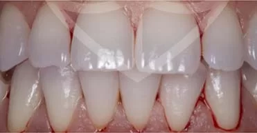 After - Nuvo Dental Implant Centre
