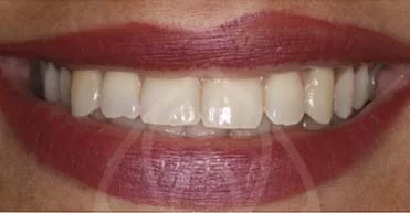 Before - Nuvo Dental Implant Centre