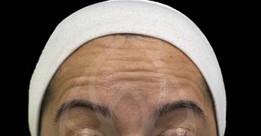 Before - Nuvo Dental Implant Centre