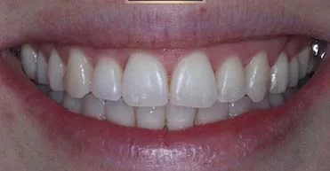 After - Nuvo Dental Implant Centre