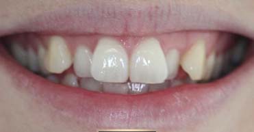 Before - Nuvo Dental Implant Centre