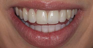 After - Nuvo Dental Implant Centre