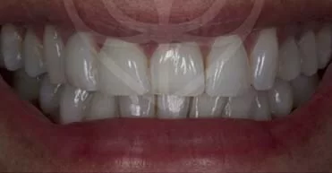After - Nuvo Dental Implant Centre