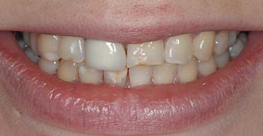 Before - Nuvo Dental Implant Centre